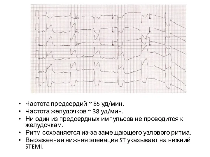 Частота предсердий ~ 85 уд/мин. Частота желудочков ~ 38 уд/мин. Ни