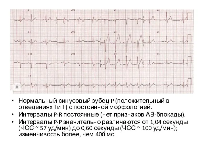 Нормальный синусовый зубец P (положительный в отведениях I и II) с