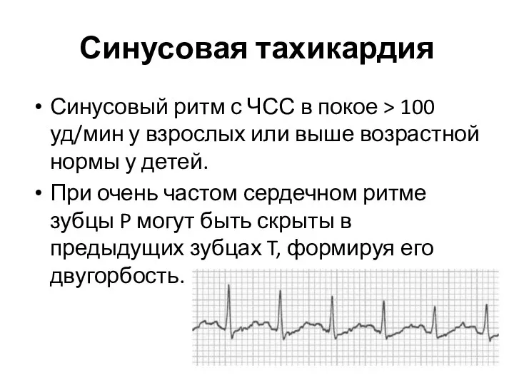 Синусовая тахикардия Синусовый ритм с ЧСС в покое > 100 уд/мин