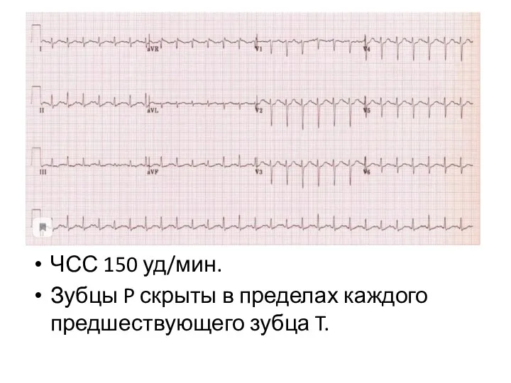 ЧСС 150 уд/мин. Зубцы P скрыты в пределах каждого предшествующего зубца T.