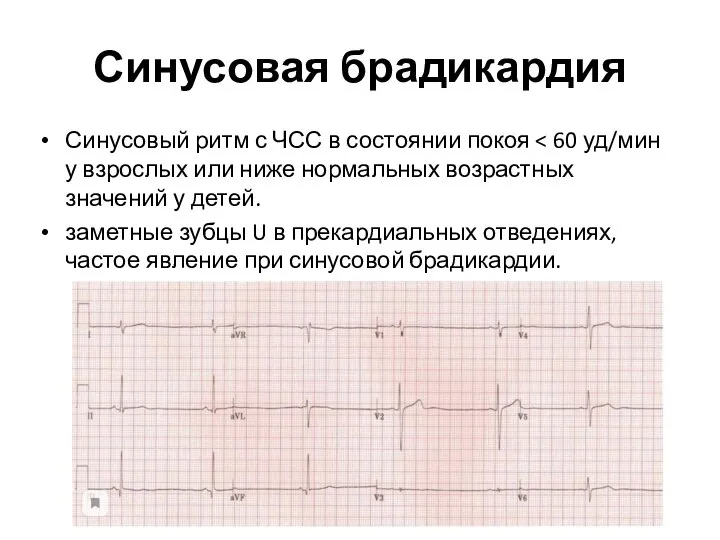 Синусовая брадикардия Синусовый ритм с ЧСС в состоянии покоя заметные зубцы