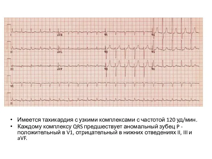 Имеется тахикардия с узкими комплексами с частотой 120 уд/мин. Каждому комплексу