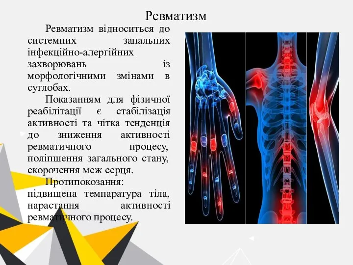 Ревматизм Ревматизм відноситься до системних запальних інфекційно-алергійних захворювань із морфологічними змінами