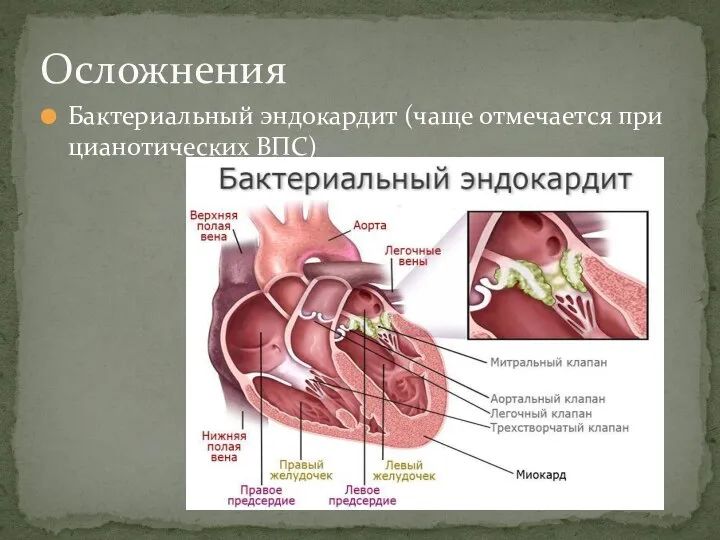 Бактериальный эндокардит (чаще отмечается при цианотических ВПС) Осложнения