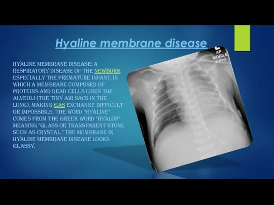 Hyaline membrane disease HYALINE MEMBRANE DISEASE: A RESPIRATORY DISEASE OF THE