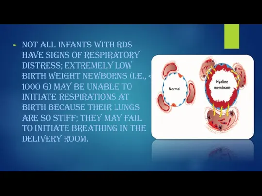 Not all infants with RDS have signs of respiratory distress; extremely low birth weight newborns (i.e.,