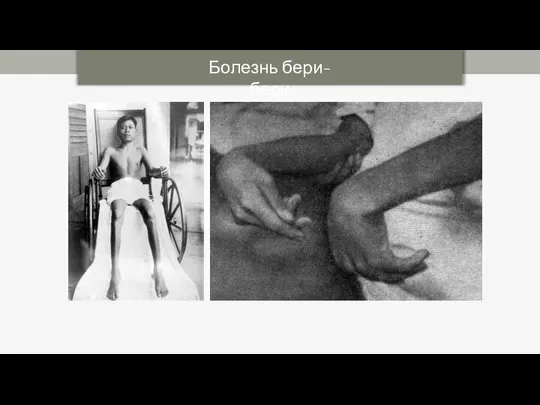 Болезнь бери-бери