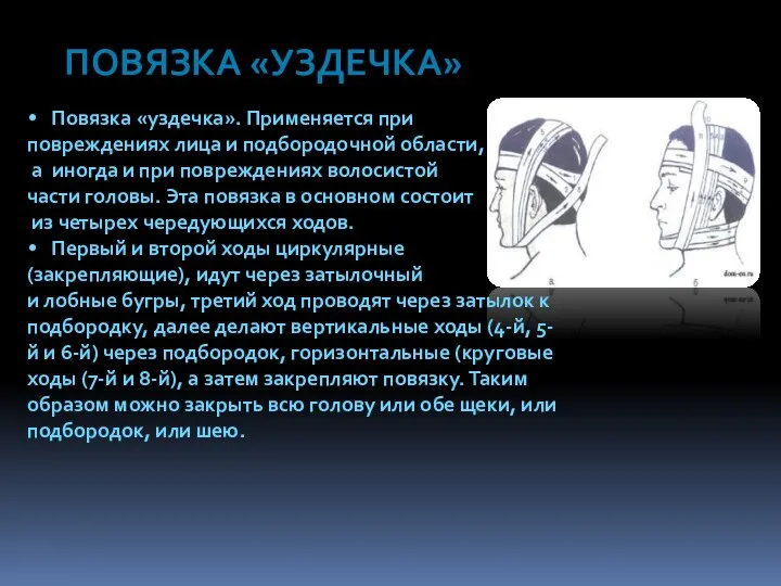 ПОВЯЗКА «УЗДЕЧКА» Повязка «уздечка». Применяется при повреждениях лица и подбородочной области,