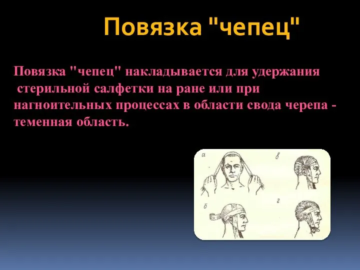 Повязка "чепец" Повязка "чепец" накладывается для удержания стерильной салфетки на ране