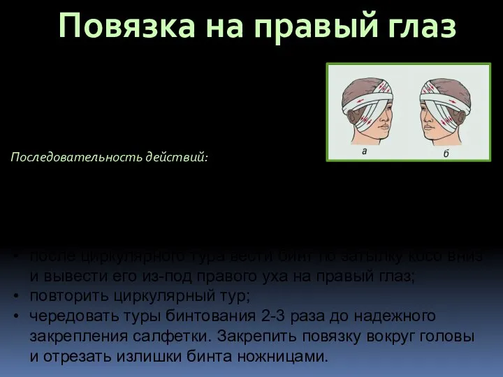 Повязка на правый глаз (на левый глаз все туры бинтования идут