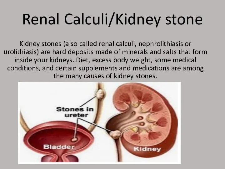 Renal Calculi/Kidney stone Kidney stones (also called renal calculi, nephrolithiasis or