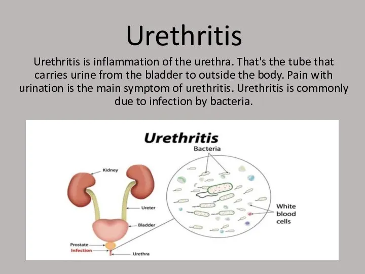 Urethritis Urethritis is inflammation of the urethra. That's the tube that