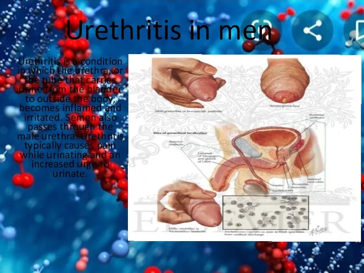 Urethritis in men Urethritis is a condition in which the urethra,