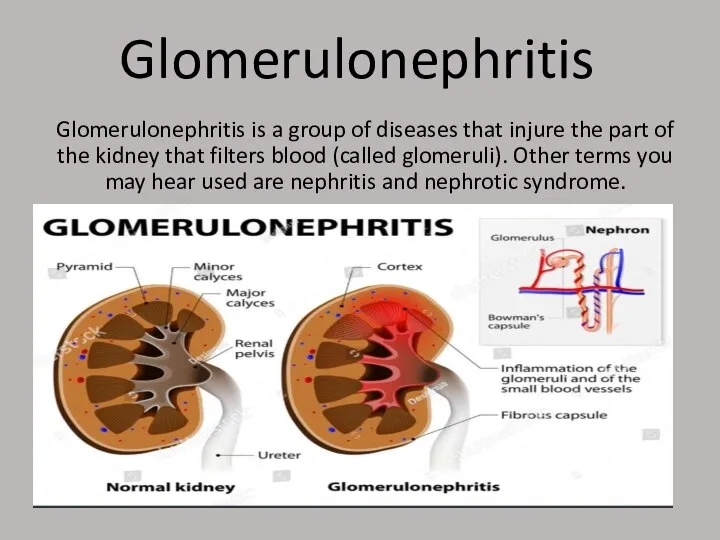 Glomerulonephritis Glomerulonephritis is a group of diseases that injure the part