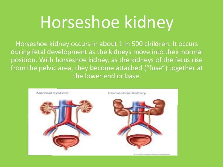 Horseshoe kidney Horseshoe kidney occurs in about 1 in 500 children.