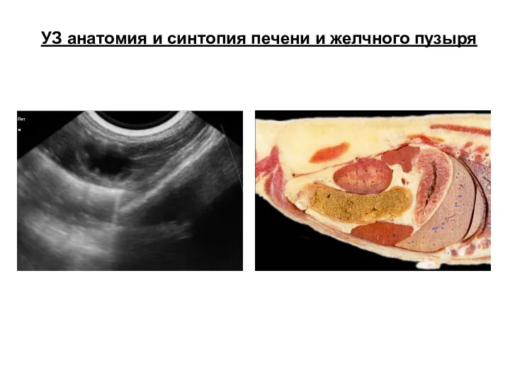 УЗ анатомия и синтопия печени и желчного пузыря