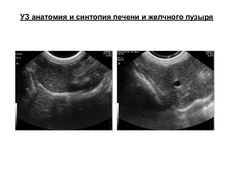 УЗ анатомия и синтопия печени и желчного пузыря