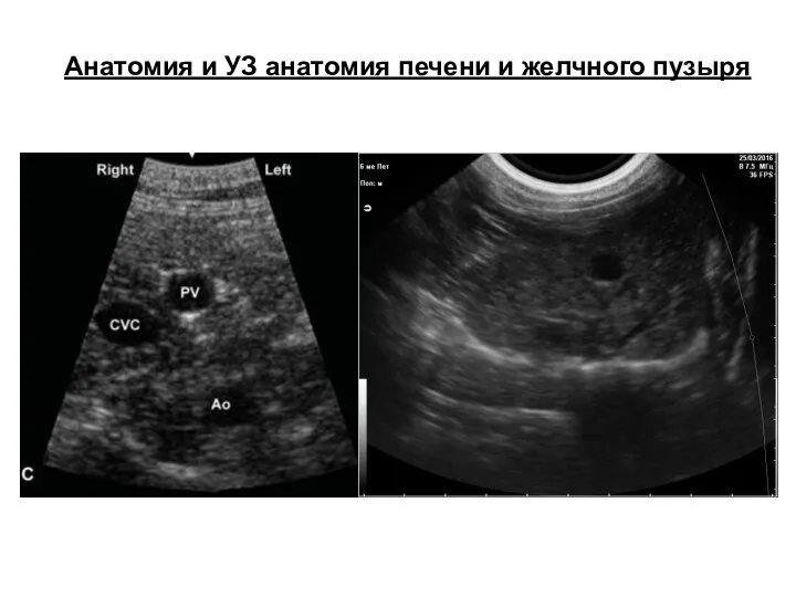 Анатомия и УЗ анатомия печени и желчного пузыря