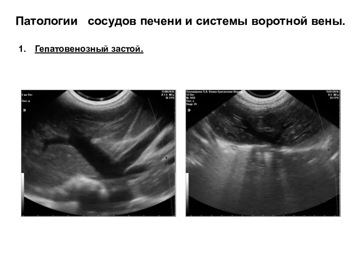 Патологии сосудов печени и системы воротной вены. Гепатовенозный застой.