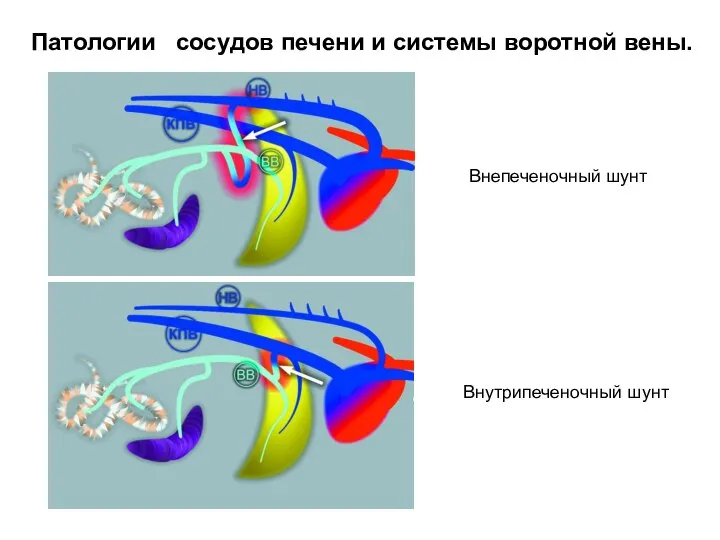 Патологии сосудов печени и системы воротной вены. Внепеченочный шунт Внутрипеченочный шунт