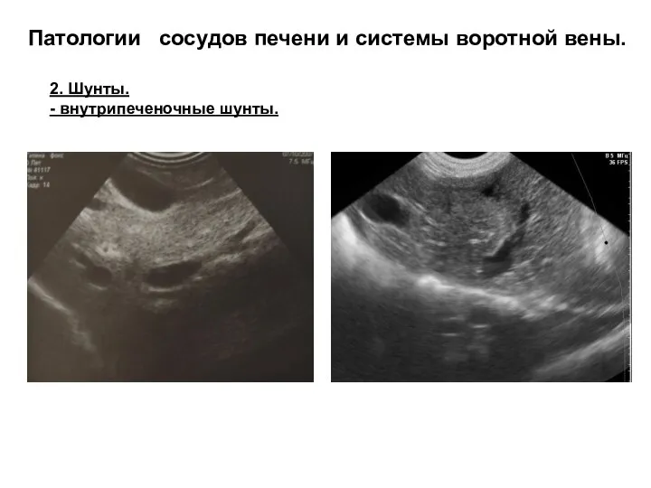 Патологии сосудов печени и системы воротной вены. 2. Шунты. - внутрипеченочные шунты.