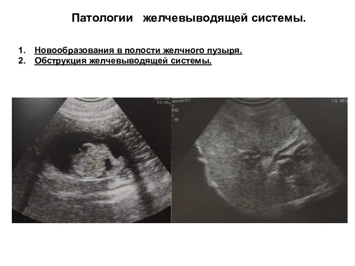 Патологии желчевыводящей системы. Новообразования в полости желчного пузыря. Обструкция желчевыводящей системы.