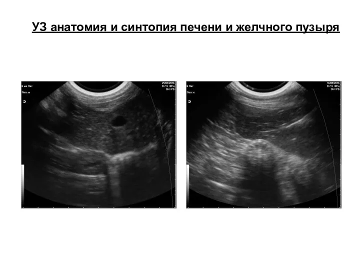 УЗ анатомия и синтопия печени и желчного пузыря