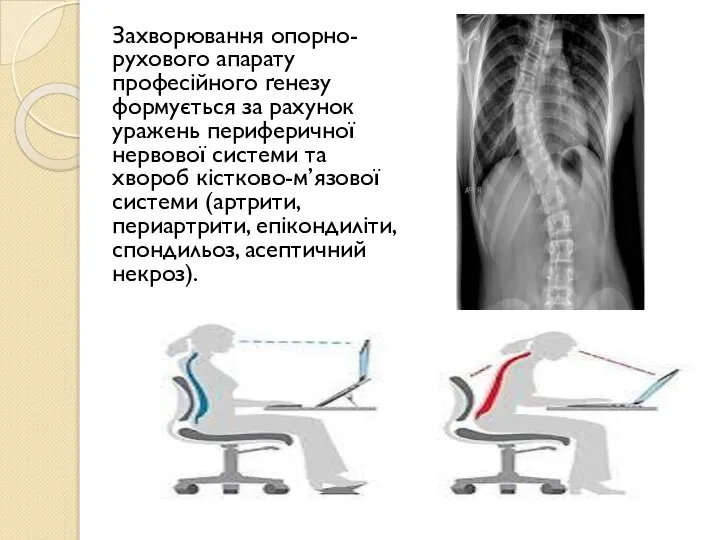 Захворювання опорно-рухового апарату професійного ґенезу формується за рахунок уражень периферичної нервової