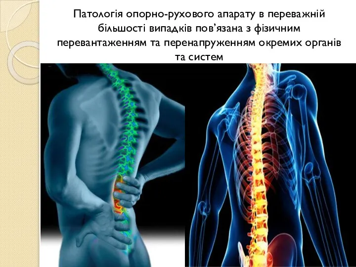 Патологія опорно-рухового апарату в переважній більшості випадків пов’язана з фізичним перевантаженням