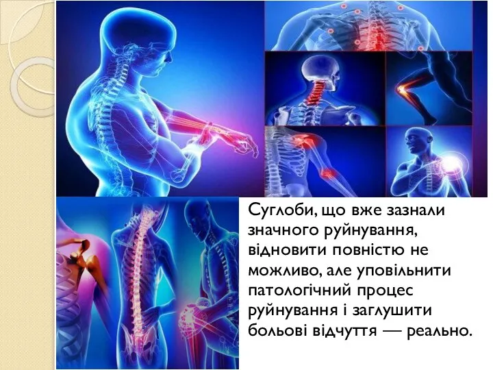 Суглоби, що вже зазнали значного руйнування, відновити повністю не можливо, але