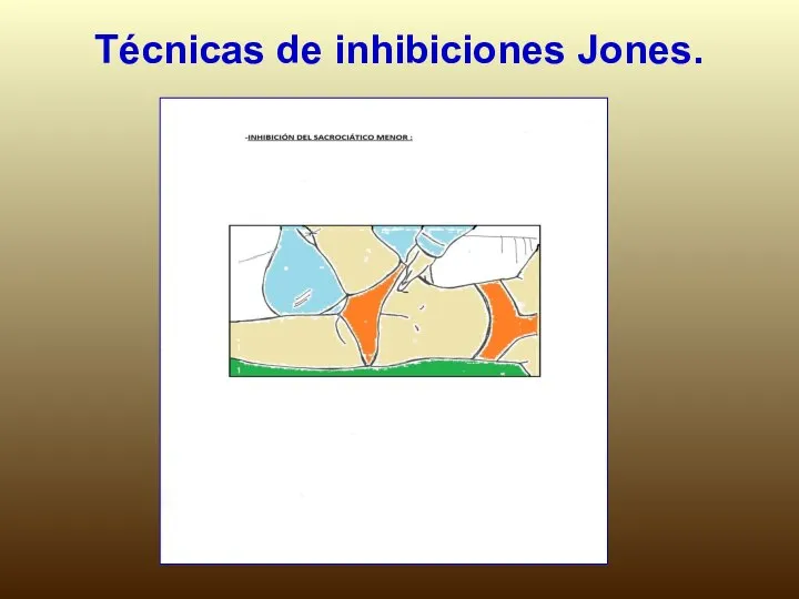 Técnicas de inhibiciones Jones.