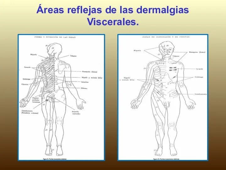 Áreas reflejas de las dermalgias Viscerales.