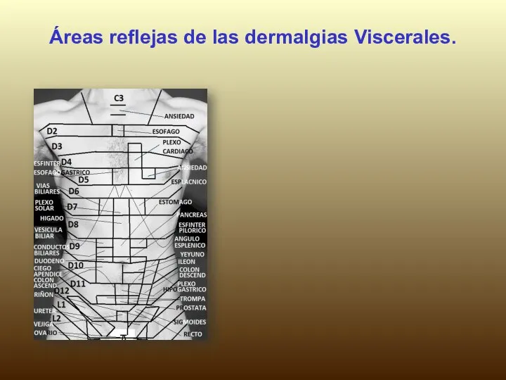 Áreas reflejas de las dermalgias Viscerales.