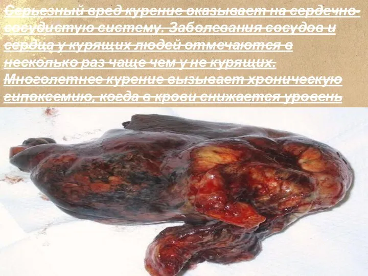 Серьезный вред курение оказывает на сердечно-сосудистую систему. Заболевания сосудов и сердца