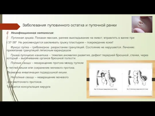 Заболевания пуповинного остатка и пупочной ранки Неинфекционная патология: Пупочная грыжа. Показан