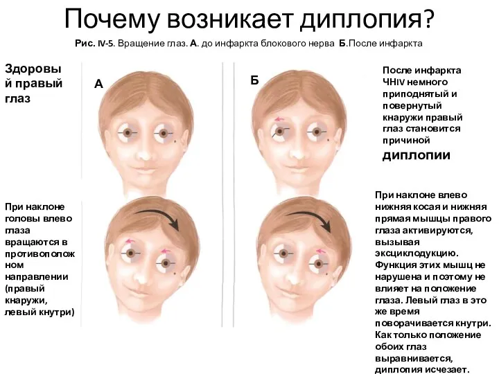 Почему возникает диплопия? Здоровый правый глаз После инфаркта ЧНIV немного приподнятый