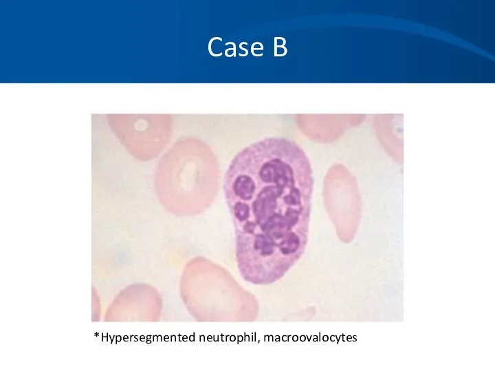 Case B *Hypersegmented neutrophil, macroovalocytes