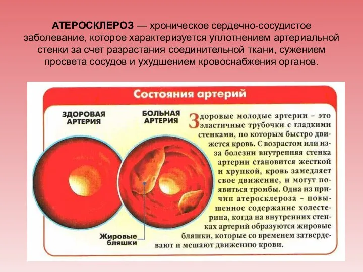 АТЕРОСКЛЕРОЗ — хроническое сердечно-сосудистое заболевание, которое характеризуется уплотнением артериальной стенки за