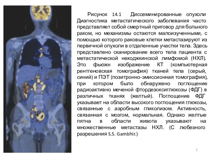 Рисунок 14.1 Диссеминированные опухоли Диагностика метастатического заболевания часто представляет собой смертный