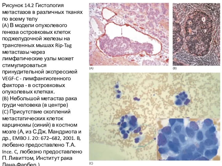Рисунок 14.2 Гистология метастазов в различных тканях по всему телу (A)