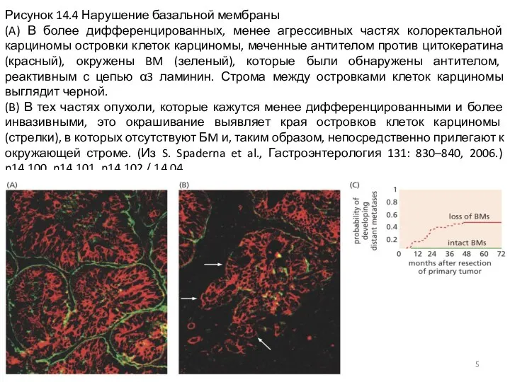 Рисунок 14.4 Нарушение базальной мембраны (A) В более дифференцированных, менее агрессивных