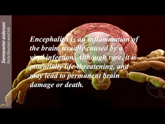 Encephalitis is an inflammation of the brain, usually caused by a