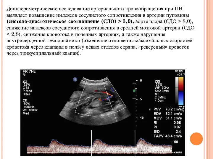 Допплерометрическое исследование артериального кровообращения при ПН выявляет повышение индексов сосудистого сопротивления