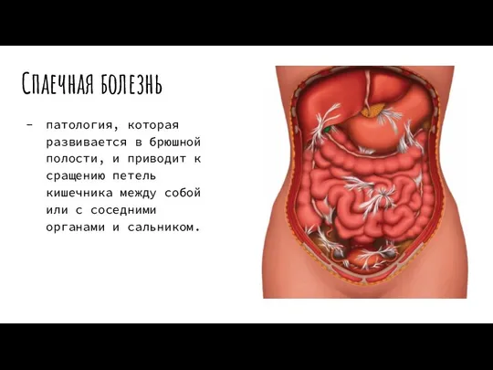 Спаечная болезнь патология, которая развивается в брюшной полости, и приводит к