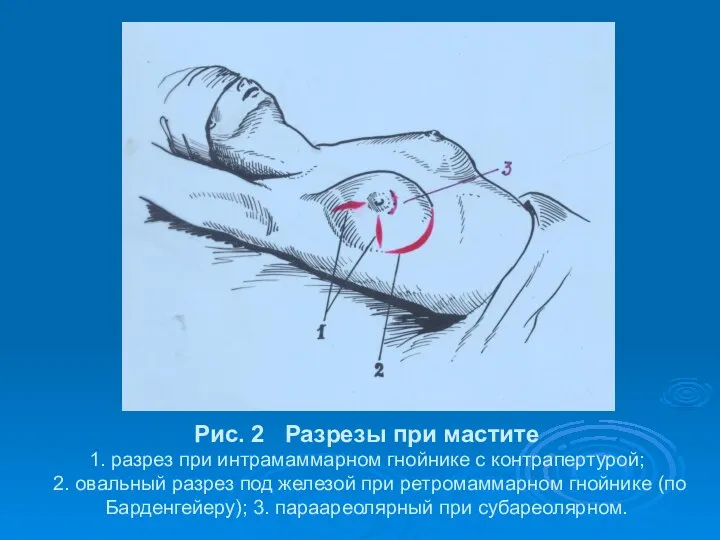 Рис. 2 Разрезы при мастите 1. разрез при интрамаммарном гнойнике с