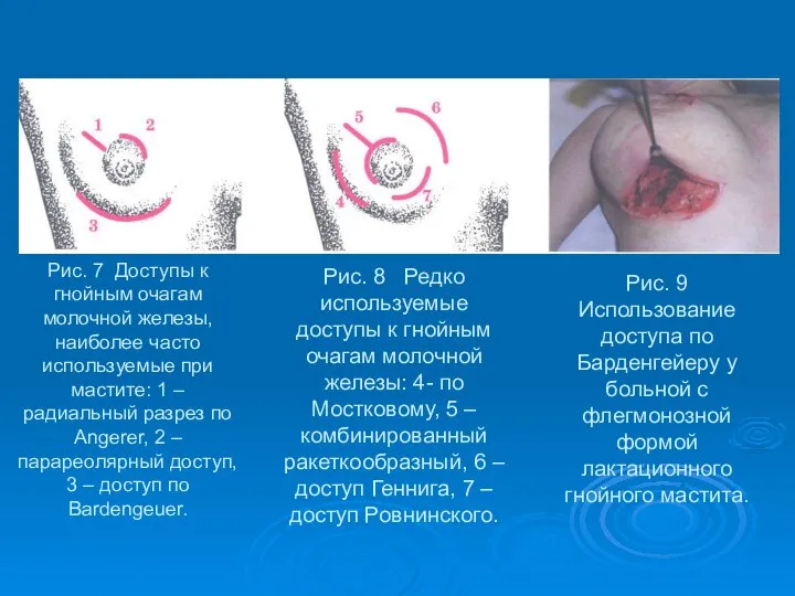 Рис. 7 Доступы к гнойным очагам молочной железы, наиболее часто используемые