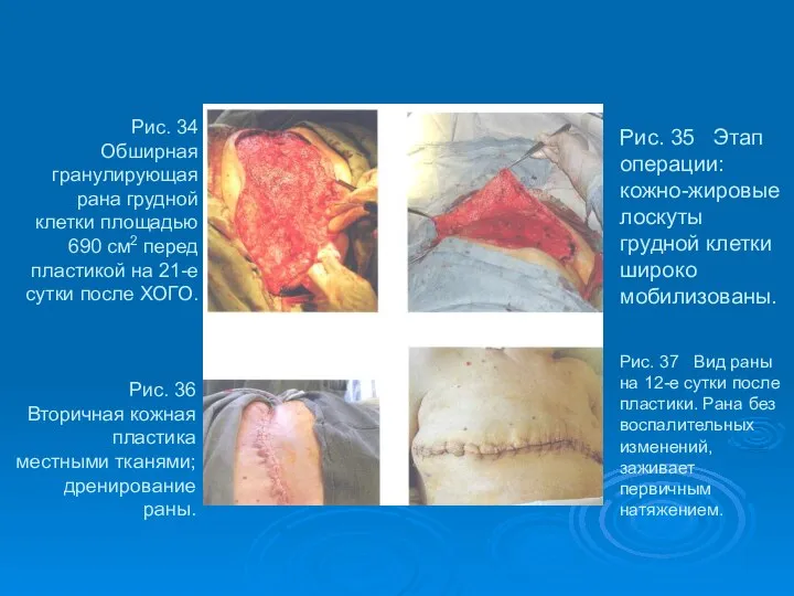 Рис. 34 Обширная гранулирующая рана грудной клетки площадью 690 см2 перед