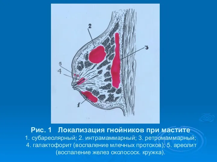 Рис. 1 Локализация гнойников при мастите 1. субареолярный; 2. интрамаммарный; 3.