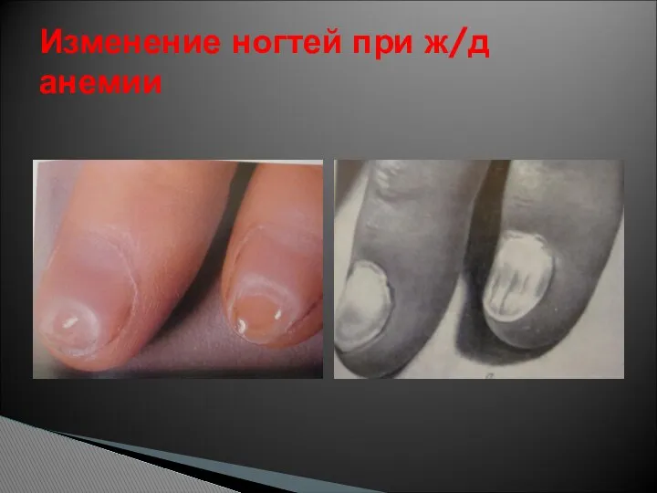 Изменение ногтей при ж/д анемии