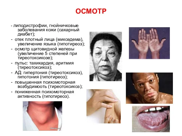 ОСМОТР - липодистрофии, гнойничковые заболевания кожи (сахарный диабет); - отек плотный